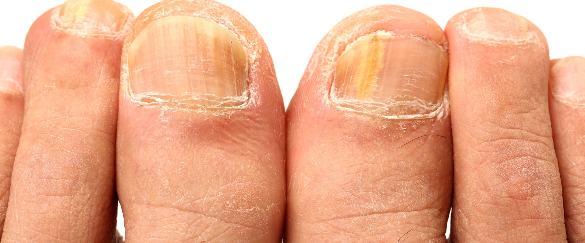 What Does Toenail Fungus Look Like? Stages and Pictures of Toenail Fungus in Detail