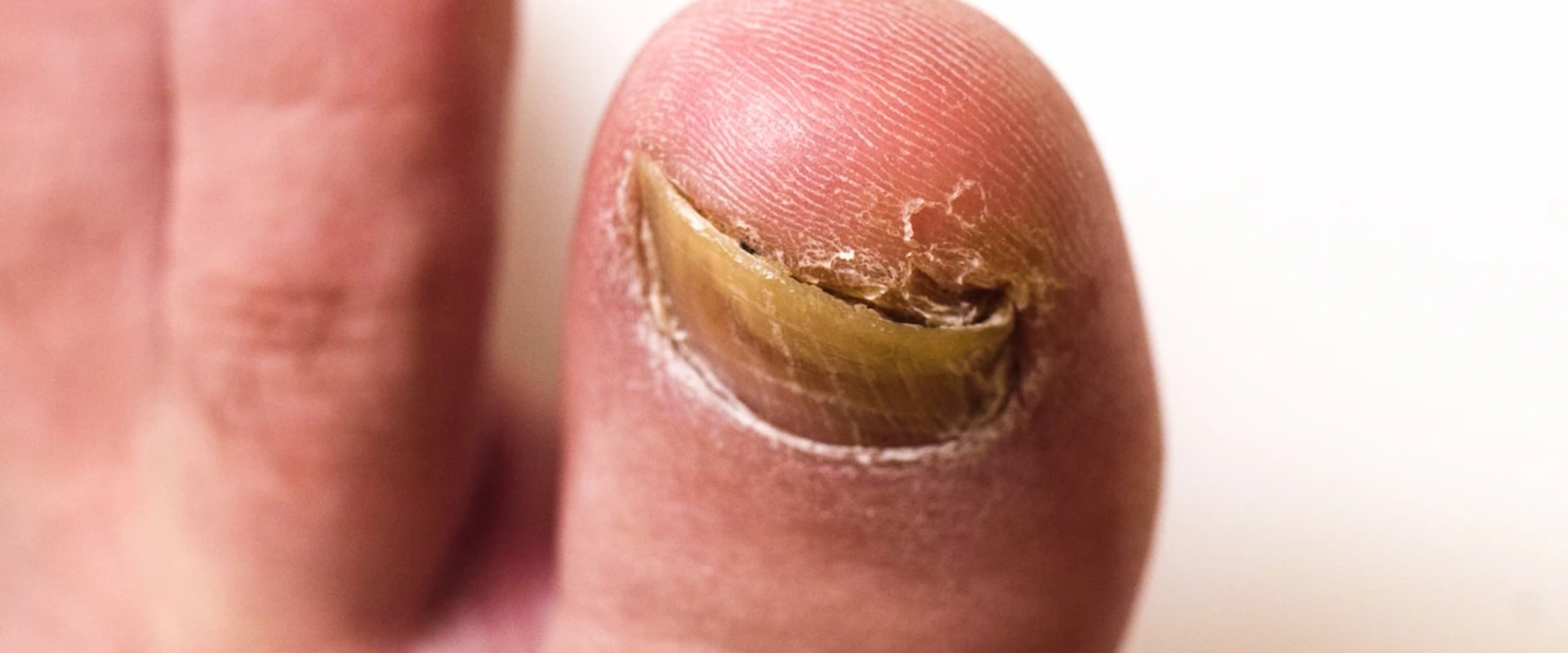 Suffering From Pain? Ram's Horn Toenail Treatment That Works