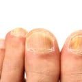 What Does Toenail Fungus Look Like? Stages and Pictures of Toenail Fungus in Detail