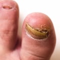 Suffering From Pain? Ram's Horn Toenail Treatment That Works
