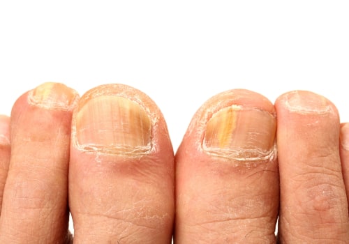 What Does Toenail Fungus Look Like? Stages and Pictures of Toenail Fungus in Detail