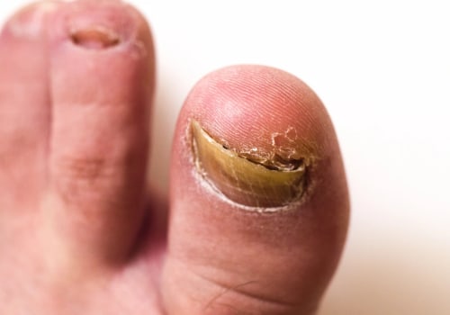 Suffering From Pain? Ram's Horn Toenail Treatment That Works